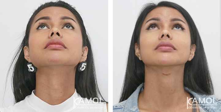 Before & After Adam's Apple Shaving