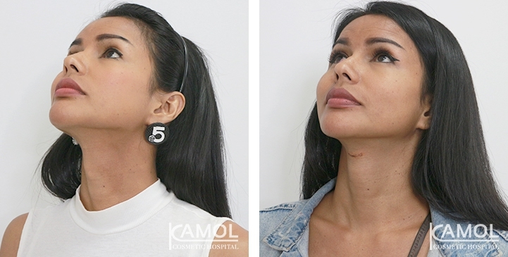 Before & After Adam's Apple Shaving