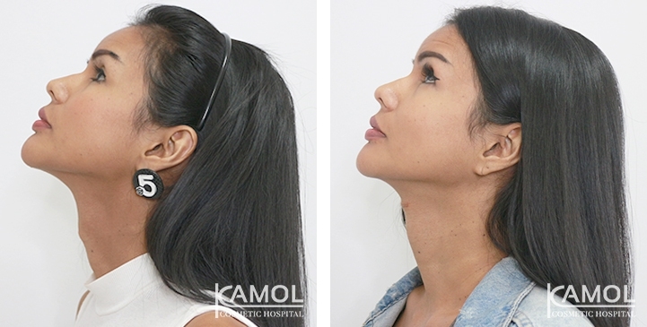 Before & After Adam's Apple Shaving
