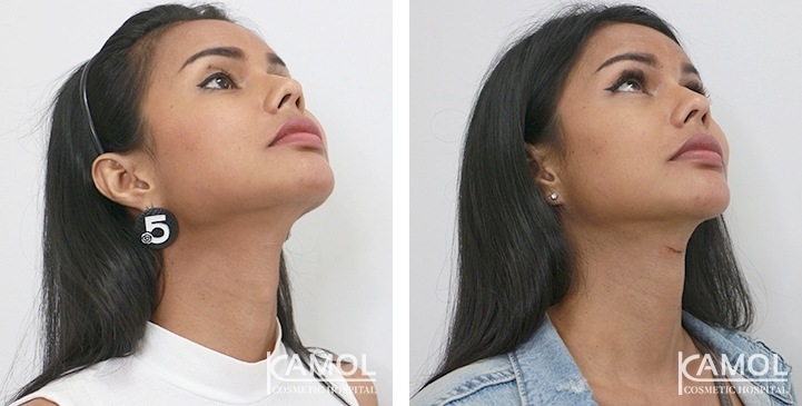 Before & After Adam's Apple Shaving