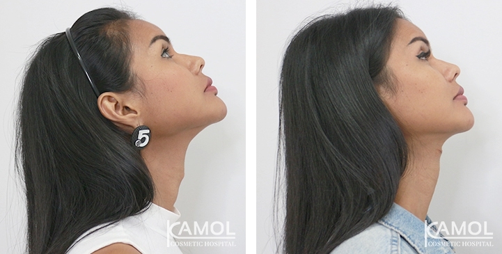 Before & After Adam's Apple Shaving