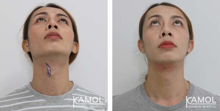 Before & After Adam's Apple Shaving