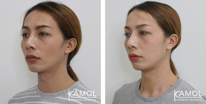 Before & After Adam's Apple Shaving