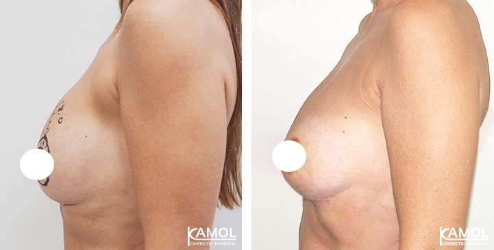 Breast Lift by Incision Scar around Areola (O scar)