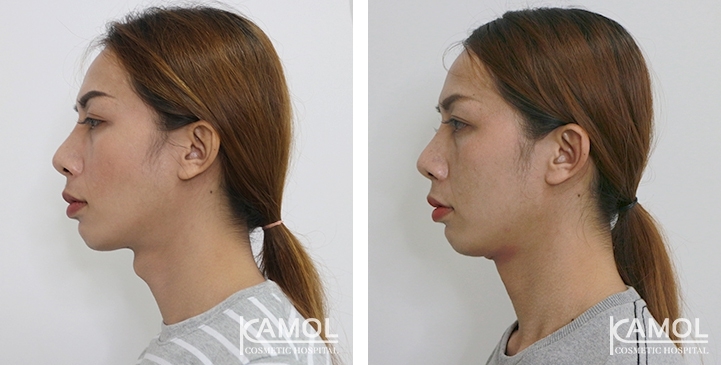 Before & After Adam's Apple Shaving