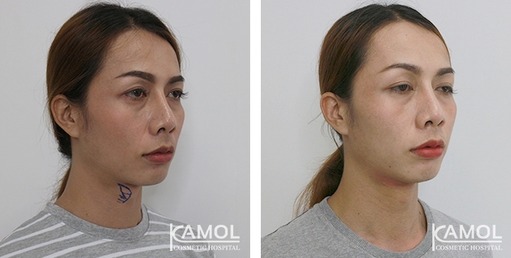 Before & After Adam's Apple Shaving