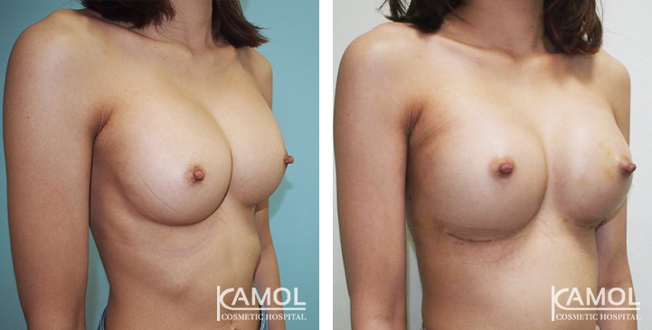 Before and After breast implant revision by Symmastia correction