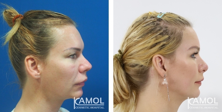 Before and After Rhinoplasty, Nose Job, Nose Surgery