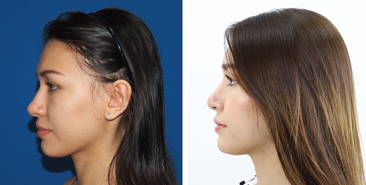 Before and After Rhinoplasty, Nose Job, Nose Surgery