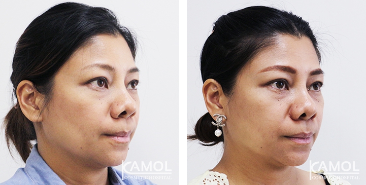 Before and After Alarplasty