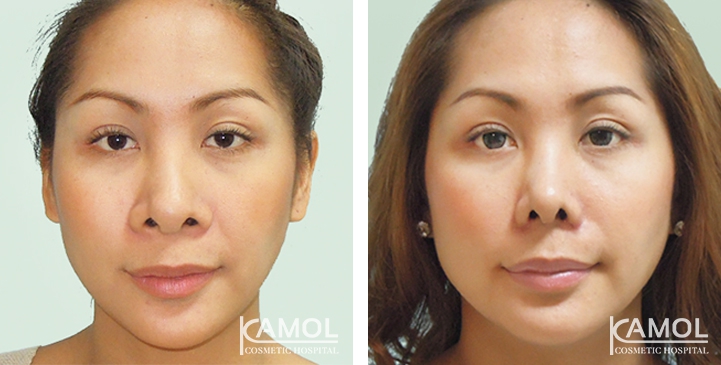 Before and After Alarplasty