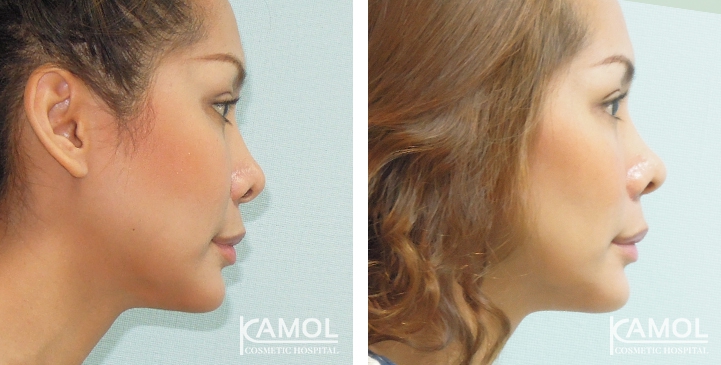Before and After Alarplasty