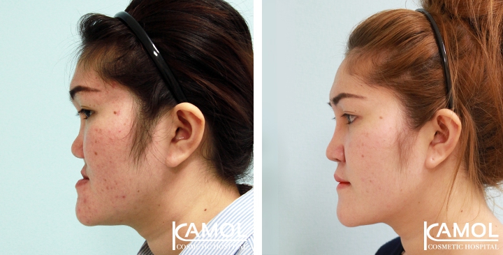 Before and After 1 month of Upper Mandibular Osteotomy, Corrective Jaw Surgery