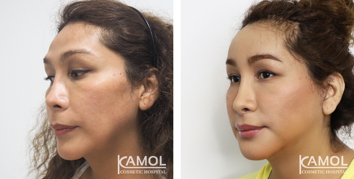 Before and After 1 month surgery,Uppder Lip Lift, Chin Reduction, Face Lift, Orbital Eyebone Shaving ,Forhead Augmentation
