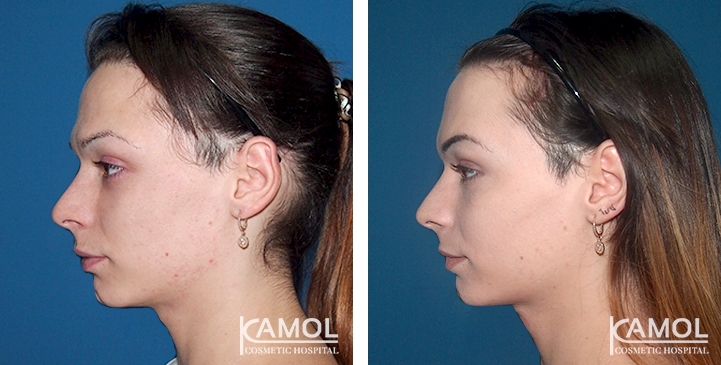 Before and After Forehead Shaving