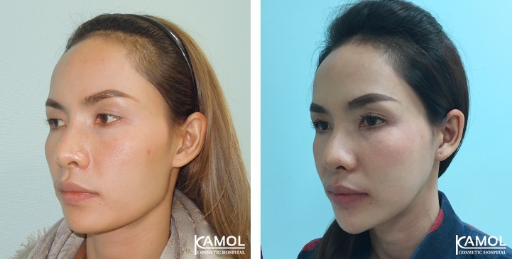 Before and After Cheekbone Reduction / Zygoma reduction / Chin Reduction