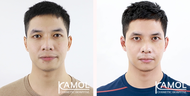 Before & After Masculin Nose, Front view