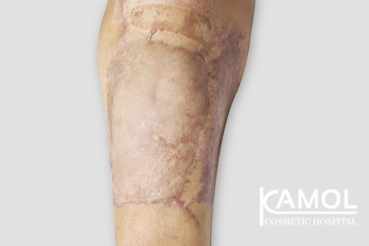 The skin graft at the donor site at front views is completely healing well at 2 months