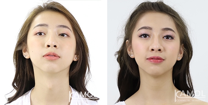 Before & After Adam's Apple Shaving