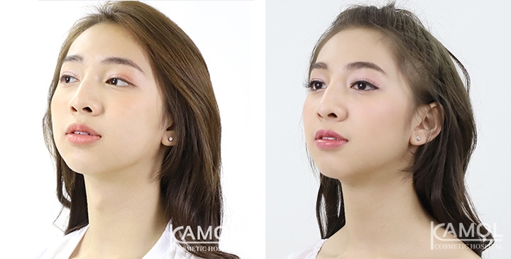 Before & After Adam's Apple Shaving