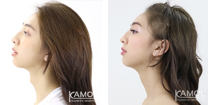 Before & After Adam's Apple Shaving