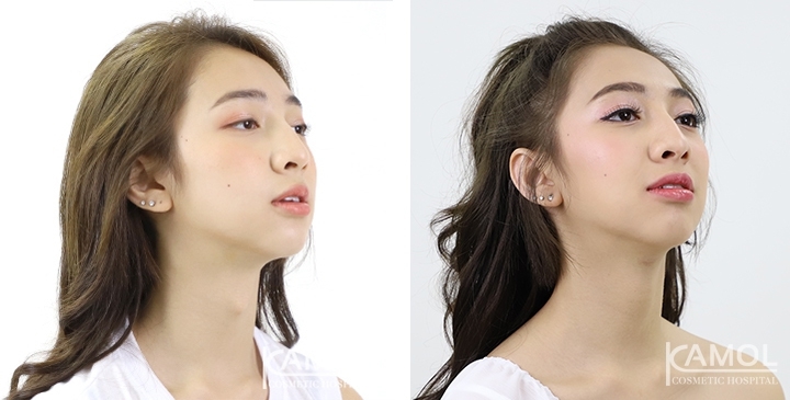 Before & After Adam's Apple Shaving