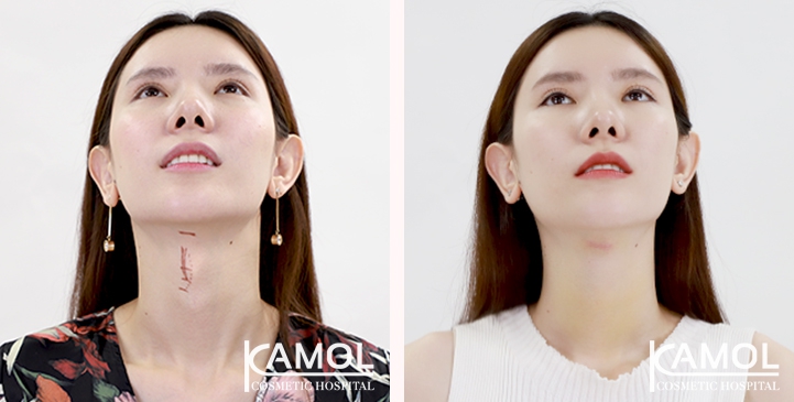 Before & After Adam's Apple Shaving