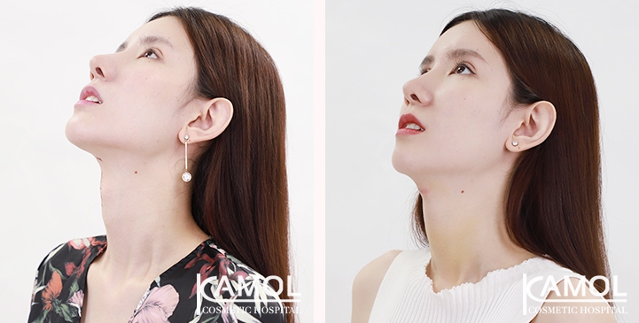 Before & After Adam's Apple Shaving