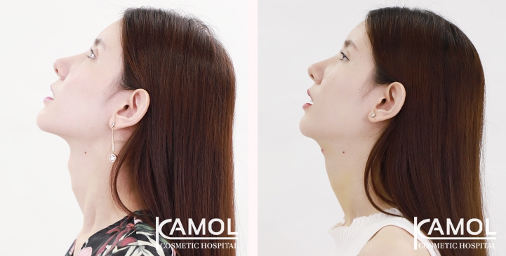 Before & After Adam's Apple Shaving