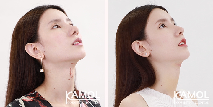 Before & After Adam's Apple Shaving