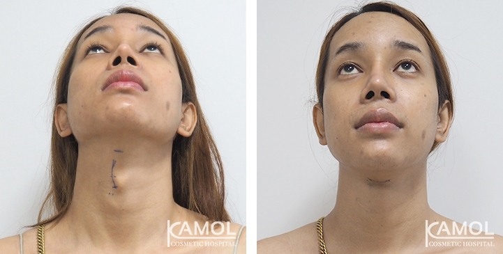 Before & After Adam's Apple Shaving