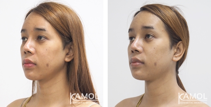 Before & After Adam's Apple Shaving