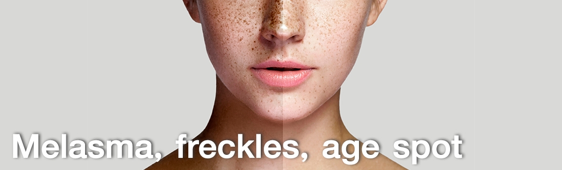 Melasma, Sardas e Manchas de Idade